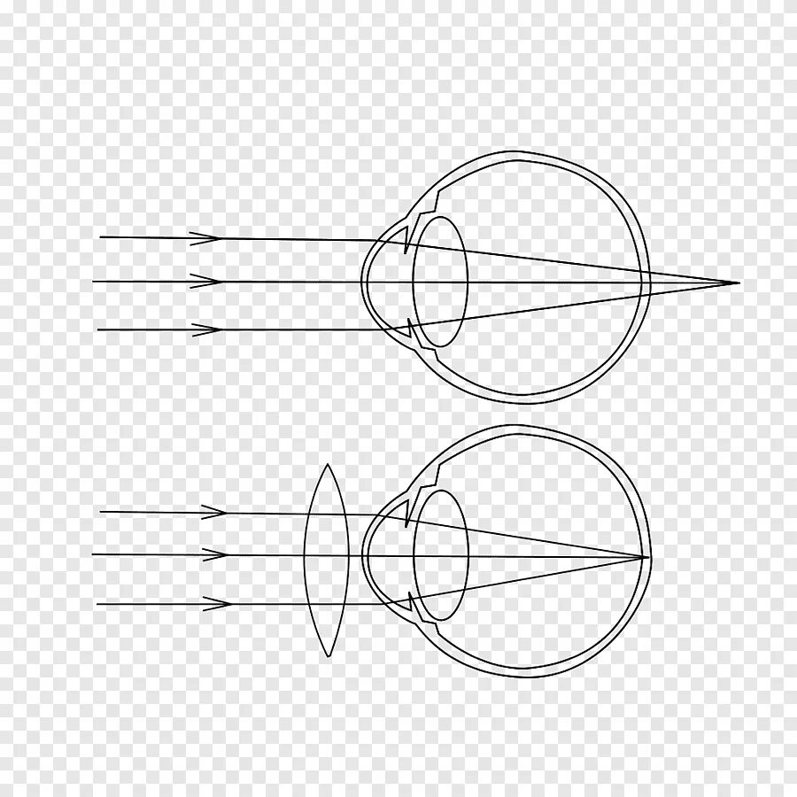 Линзы для зрения дальнозоркость. Двояковогнутая линза для близорукости. Миопия схема глаза. Контактные линзы дальнозоркости близорукости. Дальнозоркость схема глаза.