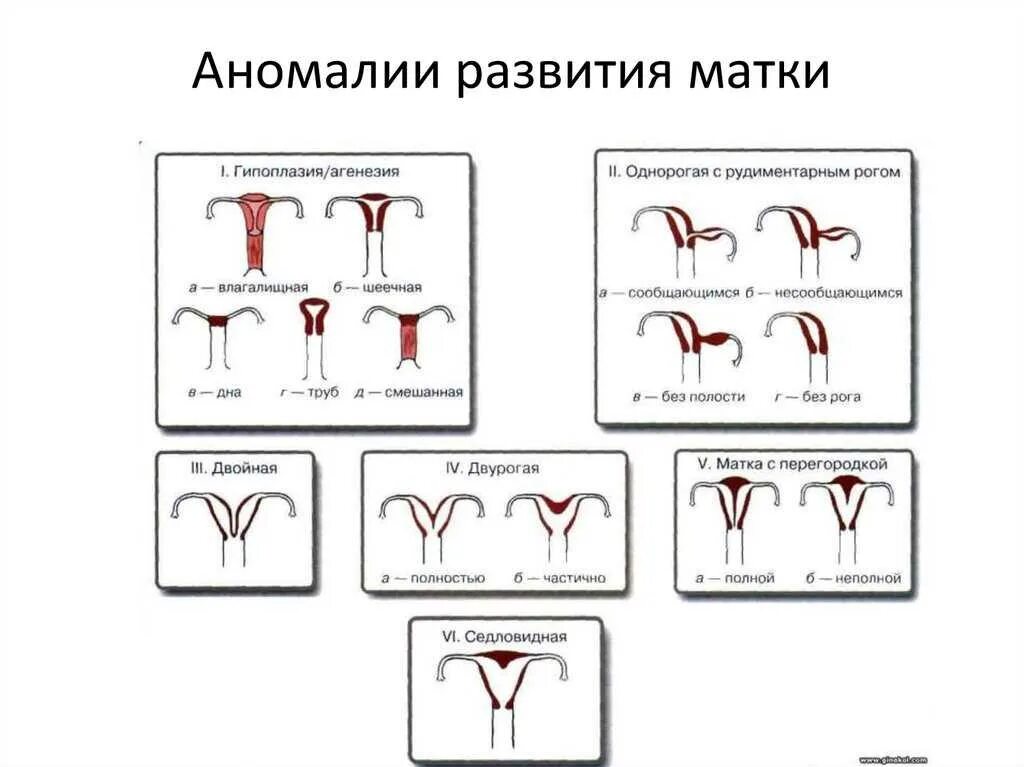 Схема аномалий развития матки. Аномалия развития матки двурогая матка. Пороки развития матки седловидная,. Однорогая и двурогая матка.