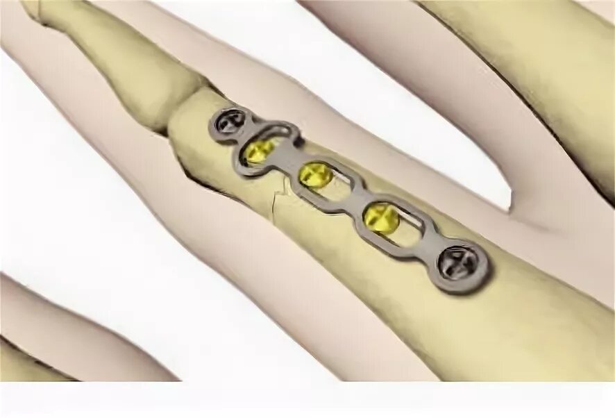 Пластина для лучевой кости Stryker. Титановая пластина для лучевой кости. Остеосинтез пястных костей пластинами. Титановые пластины для костей. Пластина в пальце