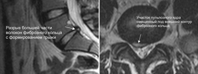Разрыв диска. Протрузия с каудальной миграцией. Секвестрированная грыжа l5-s1 мрт. Парамедианная грыжа диска на кт. Грыжа фиброзное кольцо.