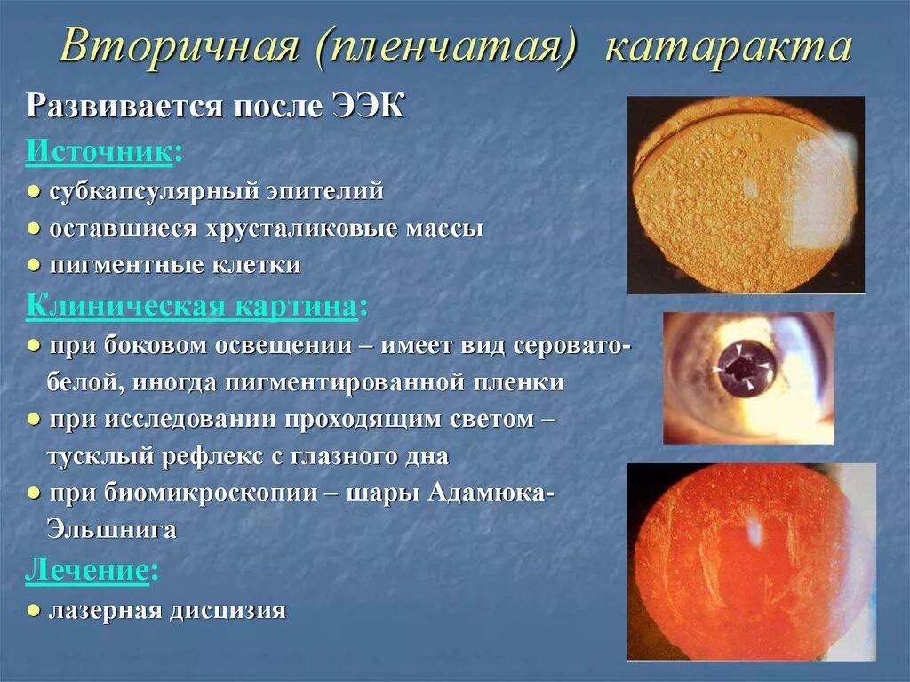 Вторичная пленчатая катаракта. Вторичная катаракта лазерная дисцизия. Вторичная катаракта фиброз задней капсулы. Симптомы вторичной катаракты. Лечение после операции катаракты