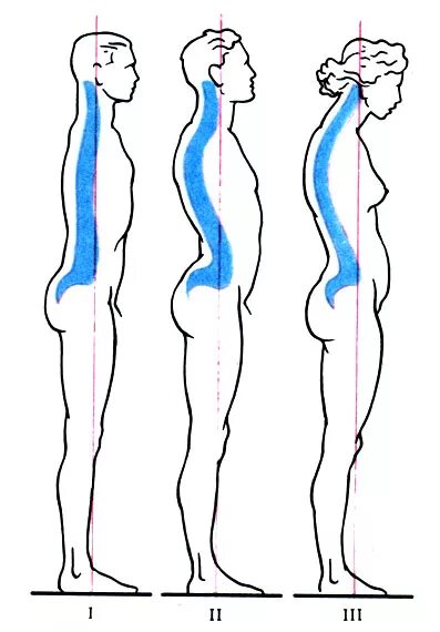 Сильный прогиб в пояснице. Осанка лордоз. Сутулость и лордоз. Форма позвоночника лордоз. Правильный лордоз поясничного отдела.