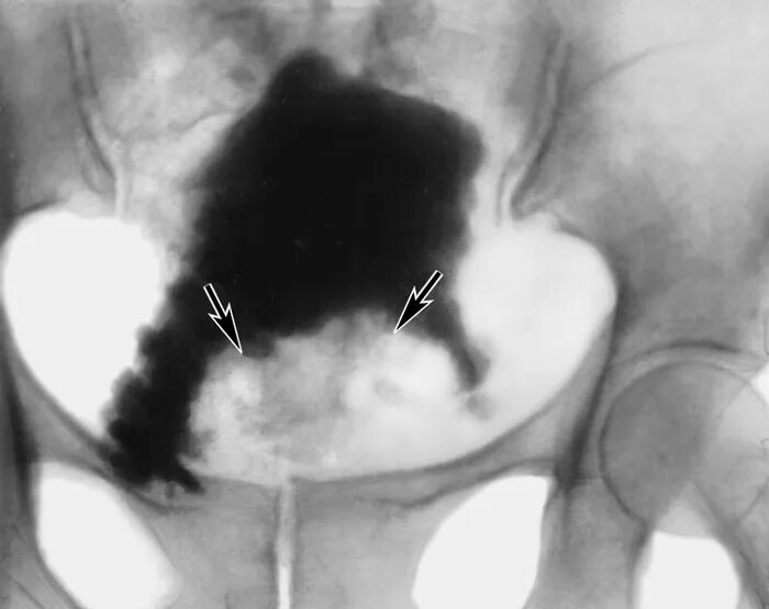 Внебрюшинный разрыв мочевого пузыря кт. Внебрюшинный разрыв мочевого пузыря цистограмма. Опухоль шейки мочевого пузыря. Опухоль мочевого пузыря рентгенограмма. Неприятно в мочевом пузыре