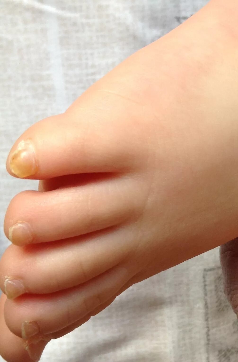 вогнутые ногти на ногах у ребенка