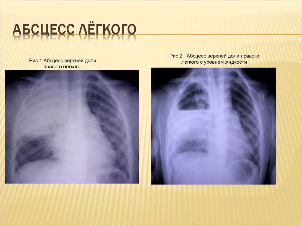 Дренирующий абсцесс легкого рентген. Абсцесс правого легкого рентгенограмма. Рентгенография абсцесса легкого. 1 абсцесс легкого