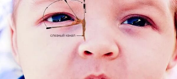 Дакриоцистит как делать массаж. Дакриоцистит новорожденных офтальма. зондирование слезного канала у новорожденного. дакриоцистит промывание слезных путей. непроходимость слезного канала зондирование.
