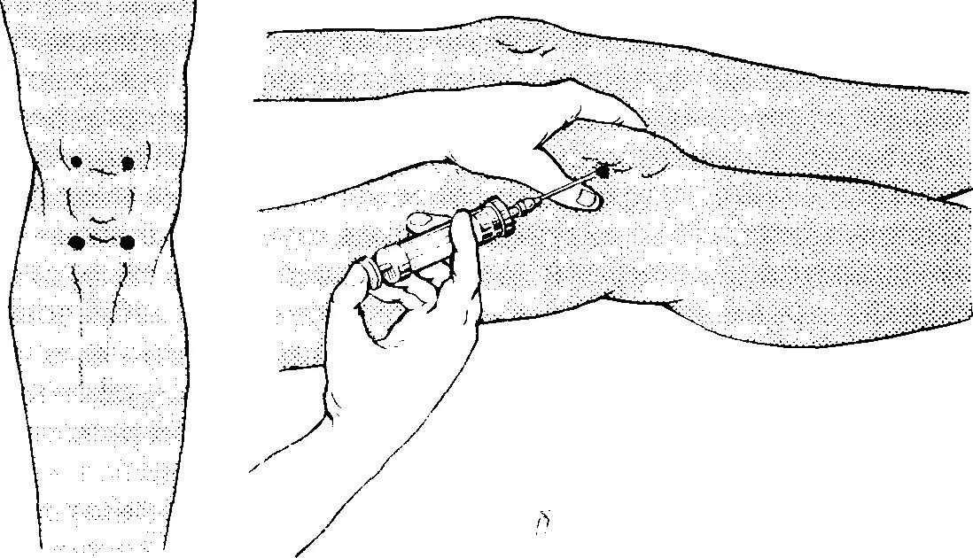 Как делают укол в коленный сустав. Техника пункции коленного сустава топографическая. Техника пункции коленного сустава топографическая анатомия. Пункция коленного сустава техника точки. Пункция коленного сустава топографическая анатомия.