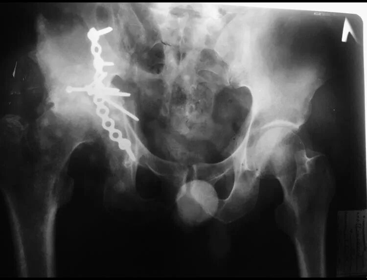 краевой перелом вертлужной впадины рентген. после перелома вертлужных впадин. после перелома вертлужных впадин. перелом вертлужной впадины тазобедренного сустава. после перелома вертлужных впадин.
