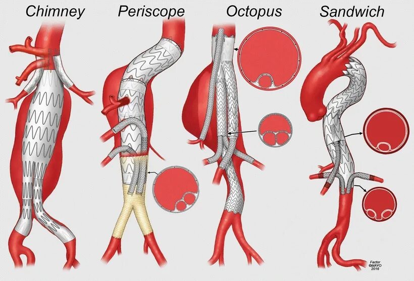 Стентирование аневризмы. Торакоабдоминальных аневризм аорты. Аневризма бифуркации аорты. Аневризма брюшной аорты стентирование. Аневризма брюшной аорты стент графтом.
