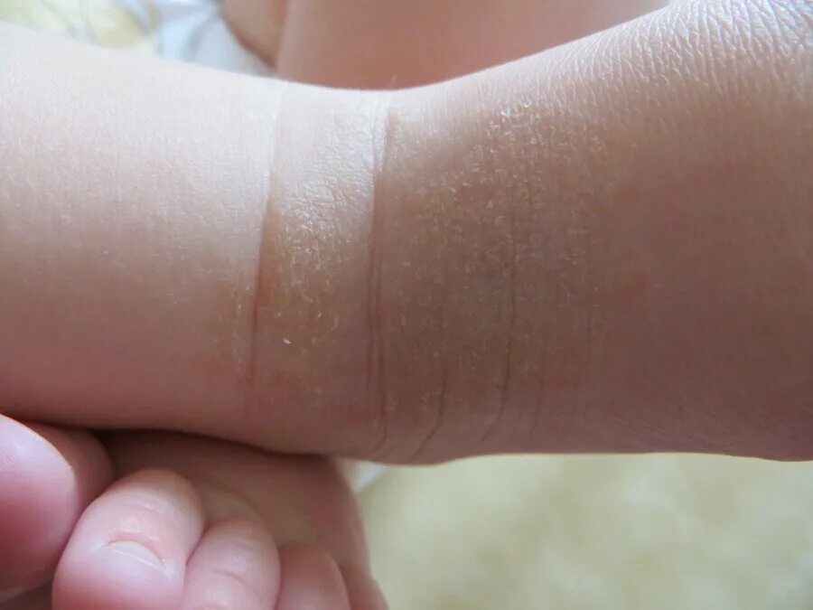 Шершавая кожа у младенца.