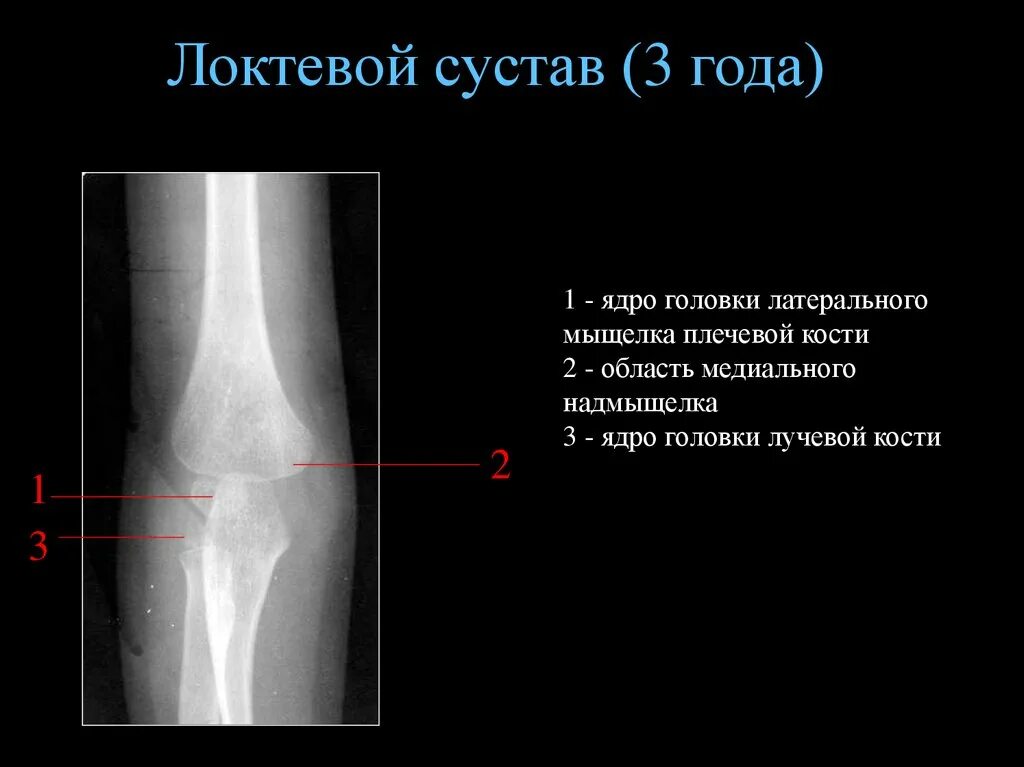 Перелом наружного мыщелка плечевой кости. Эпифизеолиз локтевого сустава рентген. Анатомия локтевого сустава кости рентген. Локтевой сустав 4 года рентген норма.