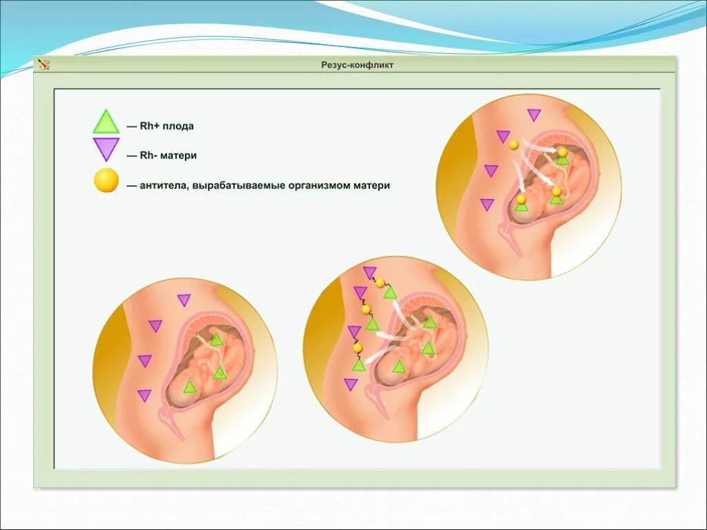 Резус конфликт возникает при. Резус-конфликт матери и плода. Осложнения резус конфликта. Схема резус конфликта матери и ребенка. Причины резус конфликта матери и плода.
