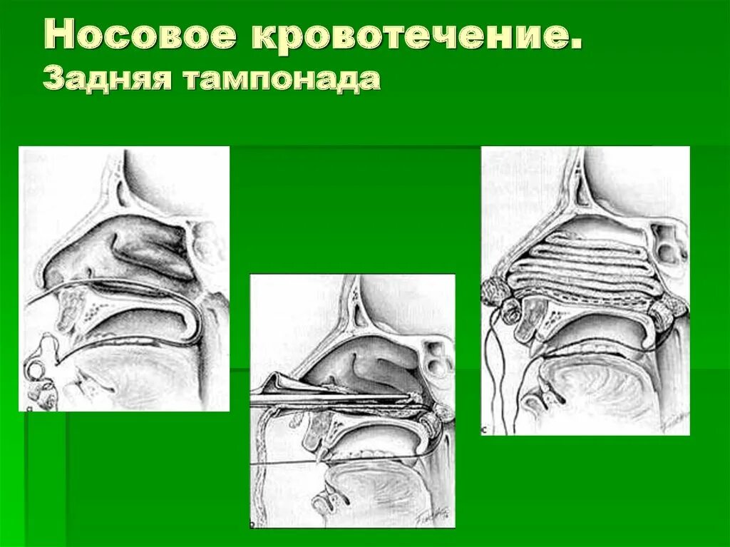 Заднее носовое кровотечение. Задняя тампонада носа при кровотечении. Инструменты для тампонады носа. Набор инструментов для задней тампонады носа.