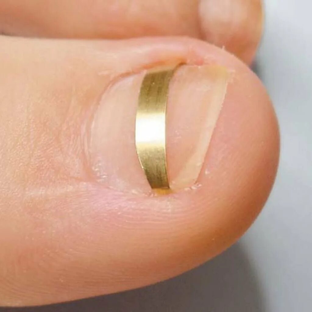 Коррекция вросшего ногтя пластинами. Вроши1ся ноготь нв ноге. Гранулема вросший ноготь. Вросший ноготь поздняя стадия. Лечить ноготь на большом пальце.