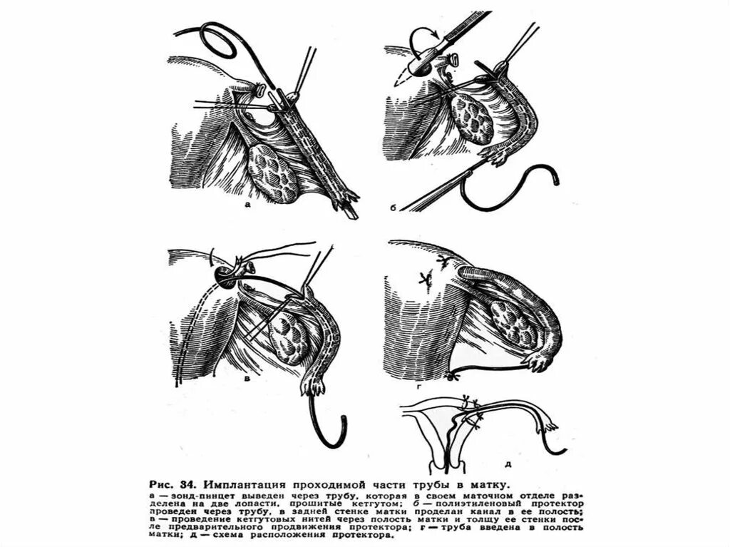 Манчестерская операция в гинекологии ход операции. Пластик операции в гинекологии. Пластическая хирургия в гинекологии. Пластчески еоперации в гинекологии. Операции матки и трубы
