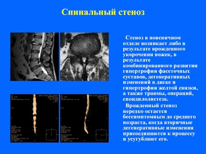 Стеноз позвоночного канала поясничного отдела на кт. Стеноз поясничного отдела мрт. Дегенеративный стеноз поясничного отдела. Спинальный стеноз.