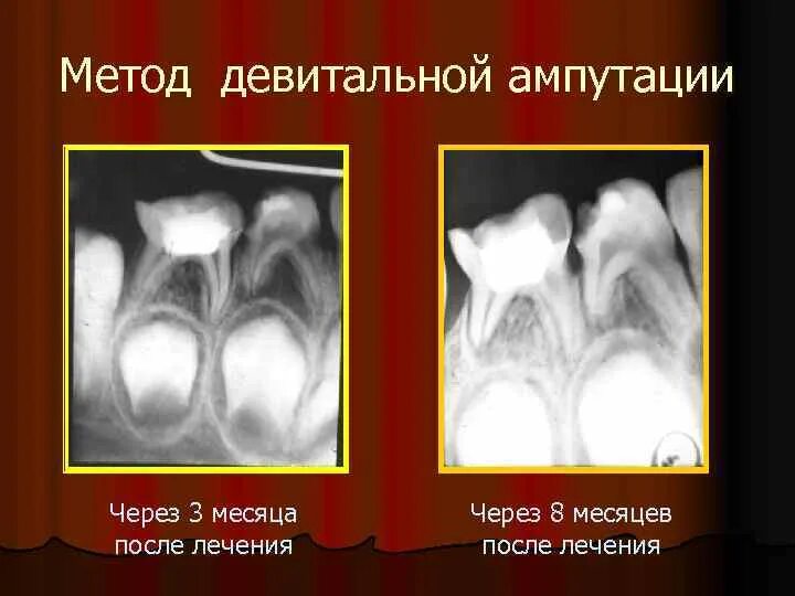 Девитальная ампутация пульпы. Методика девитальной ампутации пульпы. витальная ампутация пульпы методика. девитальная ампутация методика.