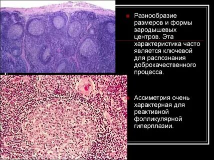 Лимфоидные фолликулы что это