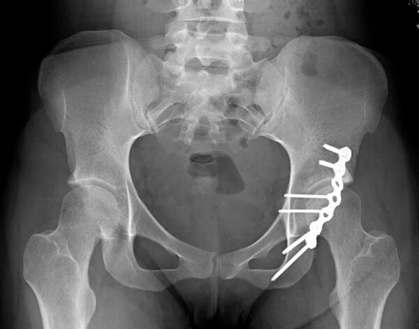 после перелома вертлужных впадин