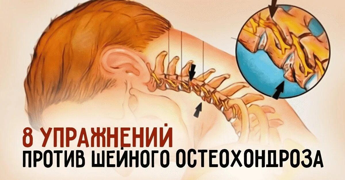 Остеохондроз шум в ушах лечение. Упражнения против шейного хондроза. Занятие для шейного отдела. Шейный остеохондроз физкультура. Упражнение против остеохон.