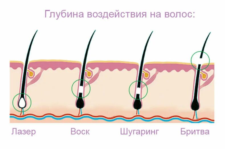 Глубина воздействия лазера для эпиляции. Принцип действия лазера для эпиляции. Воздействие лазера на волос. Глубина воздействия на волос.