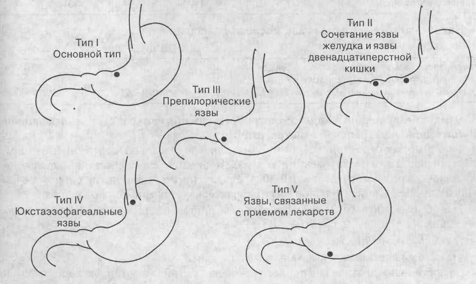 Классификация язв желудка по локализации. Язвенная болезнь желудка.12 перстной кишки локализация. Язва желудка классификация Тип. Язва желудка и 12 перстной кишки хирургия. Локализация язвы желудка