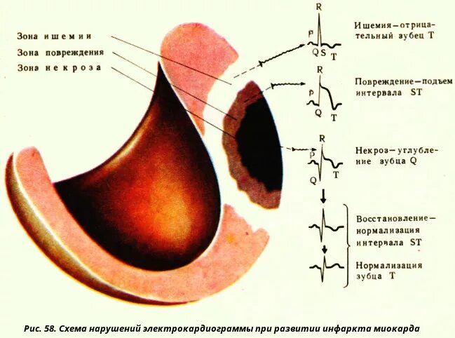 Зона ишемии. Зоны повреждения инфаркта миокарда. Зоны поражения при инфаркте миокарда. Зоны ишемии, повреждения, некроза инфаркт миокарда. Инфаркт миокарда зоны поражения.