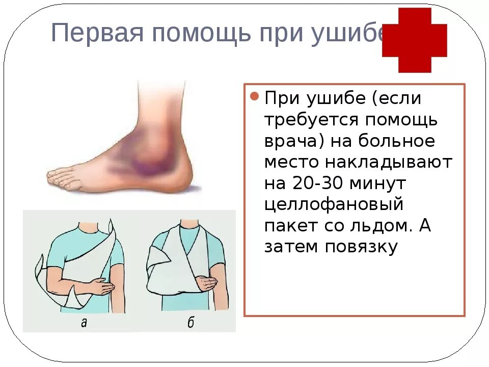 Ушиб мягких тканей последовательность действий. Первая помощь при вывихе. перваяпоиощь при вывезе. оказание первой помощи при ушибах.