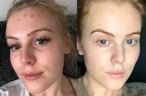 Кислоты для лица от прыщей отзывы
