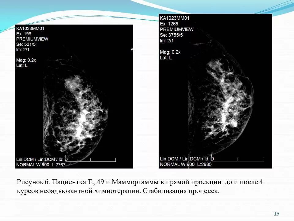 Кт после химиотерапии. Химия терапия при онкологии молочной железы. ПХТ В онкологии молочной железы. Что такое химиотерапия при онкологии молочной железы. Химия терапия при онкологии молочной железы 1 стадия.