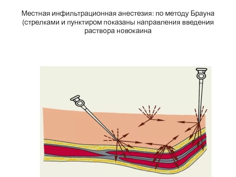 Проведение инфильтрационной анестезии