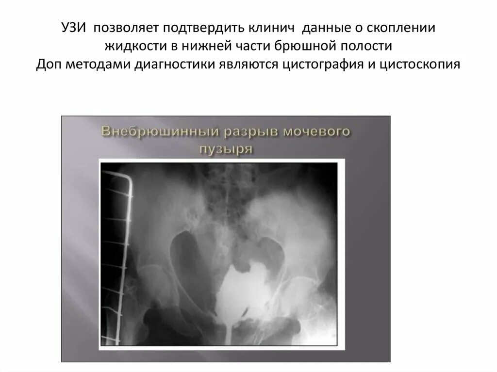 Абдоминальная травма презентация. Травмы брюшной полости презентация. Травмы органов брюшной полости. УЗИ травмы брюшной полости презентация. Синдром повреждения органов брюшной полости