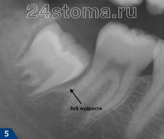 Корни 8 зуба верхней челюсти. Корни зуба мудрости на рентгене. Прорезание зубов мудрости. Зуб 8 корень