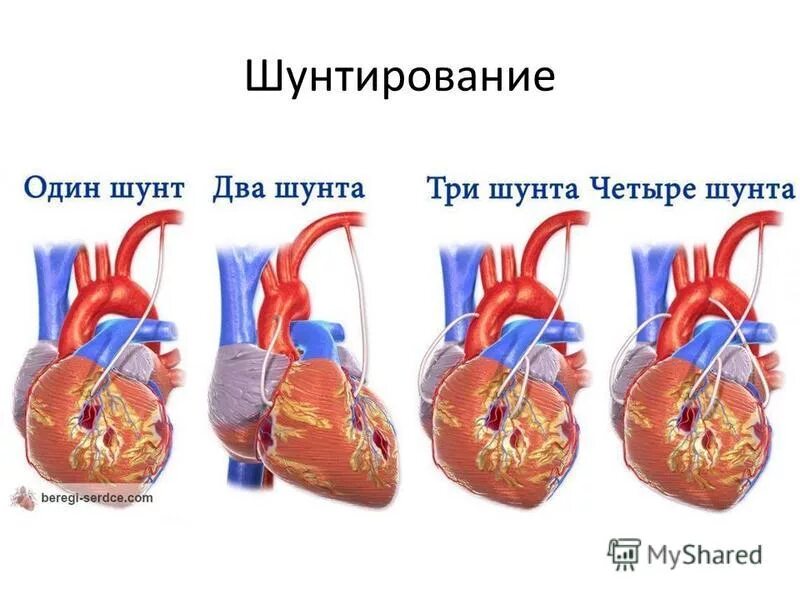 Операция коронарный сосуд. Шунтирование коронарных артерий. Артерио коронарное шунтирование. Аортокоронарное шунтирование схема. Схема операции аортокоронарного шунтирования.