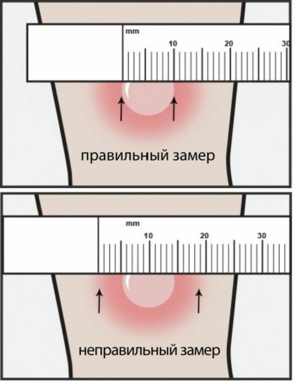 Манту: реакция, норма у детей 1-2 лет