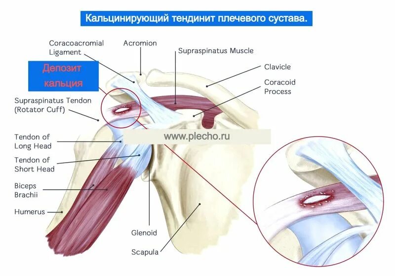 Операция разрыва сухожилия надостной мышцы. Вращательная манжета плечевого сустава анатомия. Тендиноз вращательной манжеты плечевого сустава. Кальцифицирующий тендинит надостной мышцы плечевого сустава. Ротаторная манжета плечевого сустава мышцы.