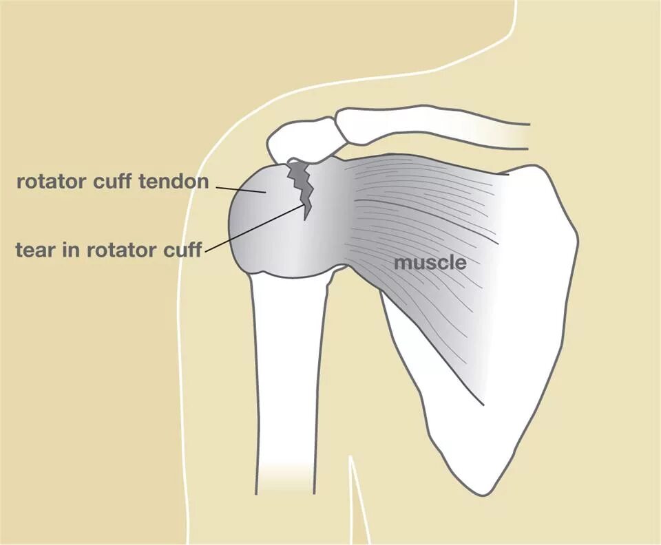 Ротаторная манжета плечевого сустава. Ротаторная манжета плечевого сустава анатомия. Повреждение ротаторная манжета. Ротаторная манжета плечевого сустава надрыв.