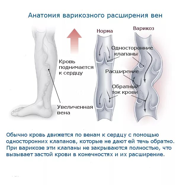 Варикозное расширение вен нижних ног. Синдромы при варикозном расширении вен нижних конечностей. Варикозное расширение вен нижних степени тяжести. Варикозное заболевания расширение вен нижних конечностей. Тяжесть в ногах вены