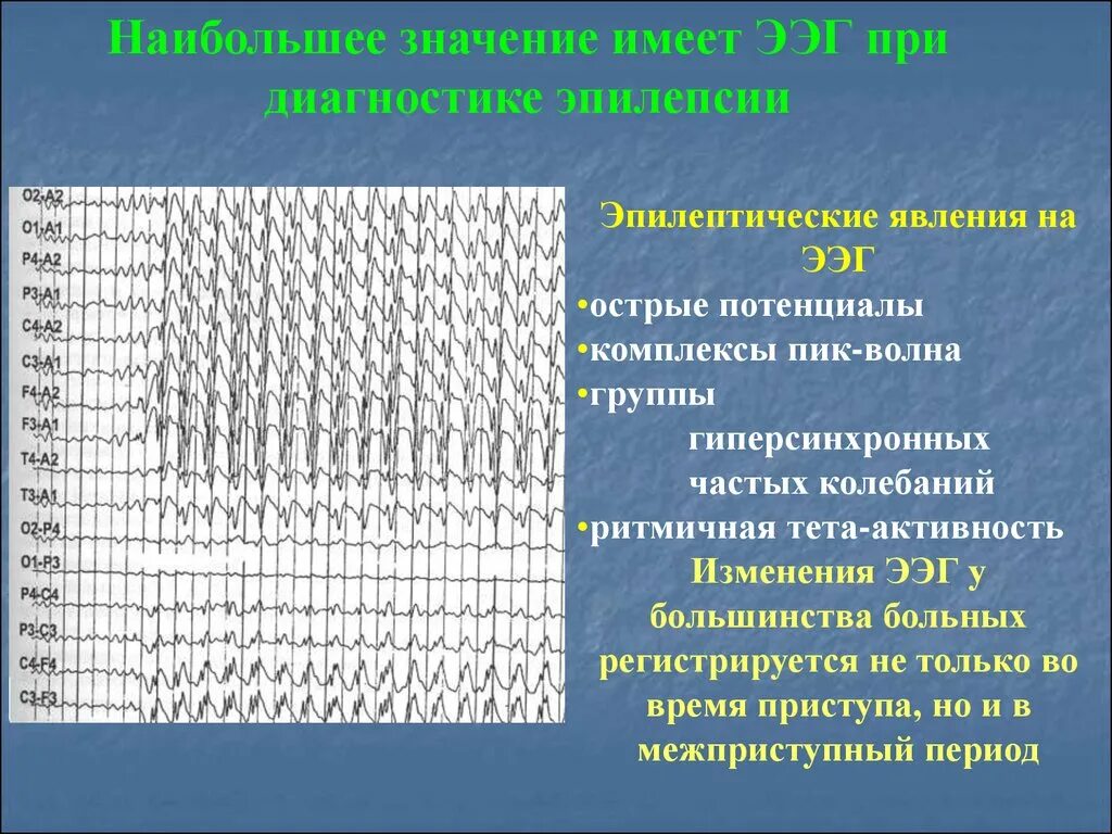 Пароксизмальная ээг. Генерализованные комплексы пик волна на ЭЭГ. ЭЭГ эпилепсия пик-волна. Изменения на ЭЭГ. ЭЭГ волны при эпилепсии.