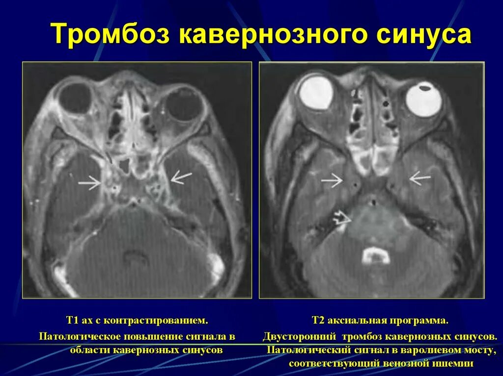 Тромбоз пещеристого синуса кт. Тромбоз вен клетчатки орбиты, кавернозного синуса. Тромбоз сигмовидного синуса на кт. Тромбоз пещеристого синуса клиника. Тромбоз на кт