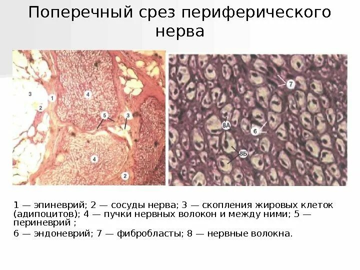 Polyneuropathy May Signify More Severe Parkinson's Disease - Neurology Advisor