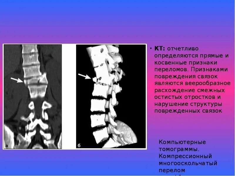 Перелом остистых отростков позвоночника l1 l2. Перелом остистого отростка с6. Перелом остистого отростка l2 l3. Перелом остистого отростка l5.