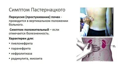 Симптом пастернацкого что это