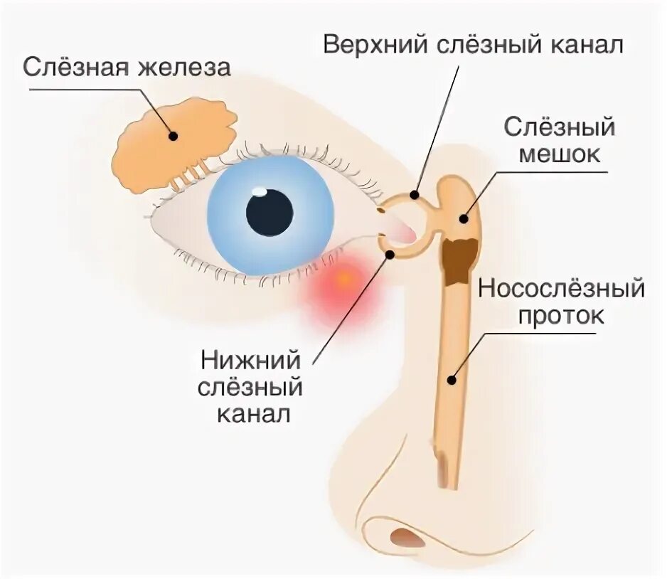 Слезно носовой канал. Воспаление слезного мешка (дакриоцистит). Непроходимость слезного канала дакриоцистит. Воспаление слезного канала дакриоцистит. Дакриоцистит промывание слезных путей.