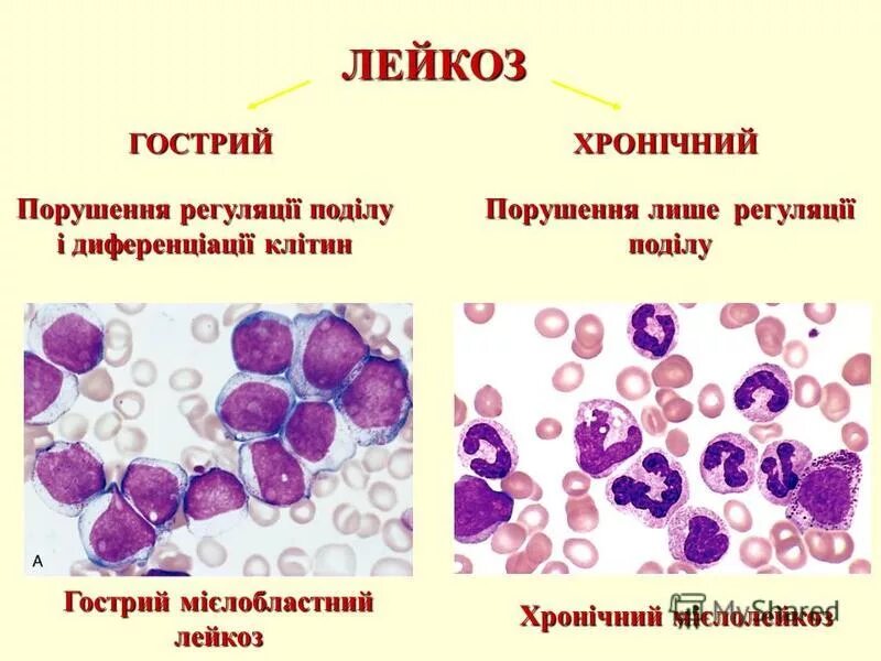 острый лейкоз картина крови. лейкоз кошек лейкоз людей. лейкоз кошек лейкоз людей. лейкоз кошек вирус передача. злокачественные новообразования; лейкозы;.