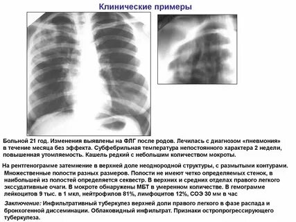 Изменение правого легкого