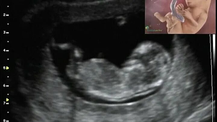 Узи 11 недель мальчик. Узи плод девочка 12 недель беременности. Пол ребёнка в 12 недель на узи. Пол плода на узи 13 недель беременности. Как выглядит мальчик на 12 недели.