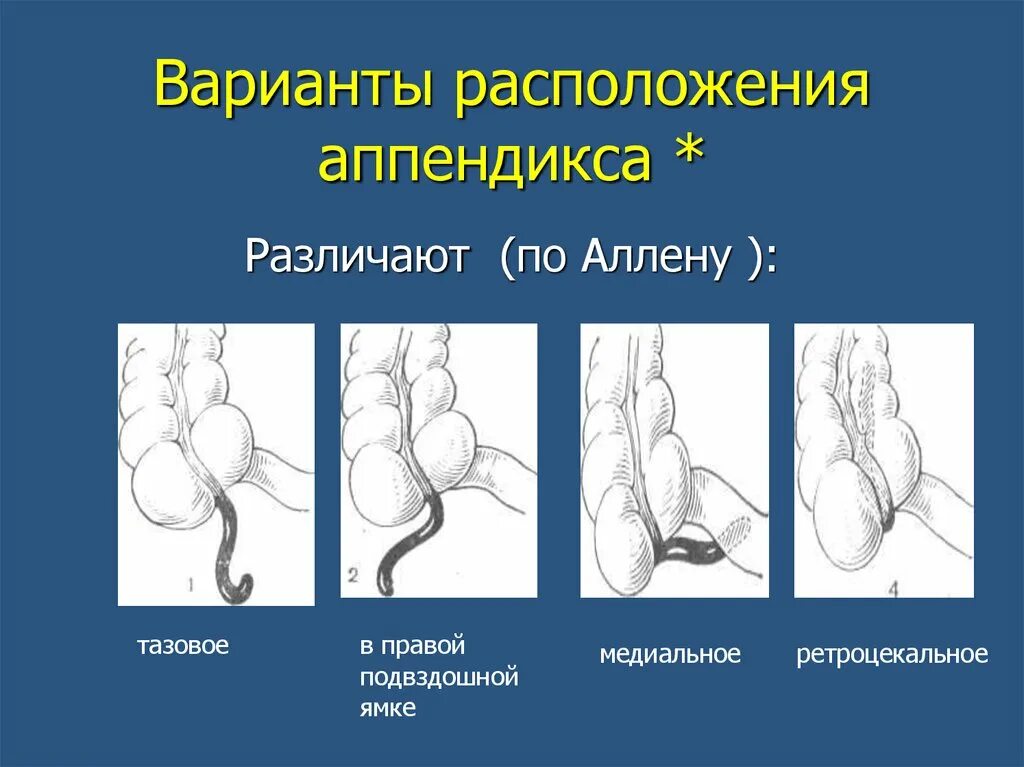 Положение при аппендиците. Ретроцекальная аппендэктомия. Ретроцекальный аппендицит. Тазовое расположение червеобразного отростка.