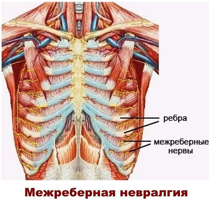 Снизу по середине. Межреберная невралгия между ребрами. Межреберная грудная невралгия. Меж ребер невралгия симптомы.