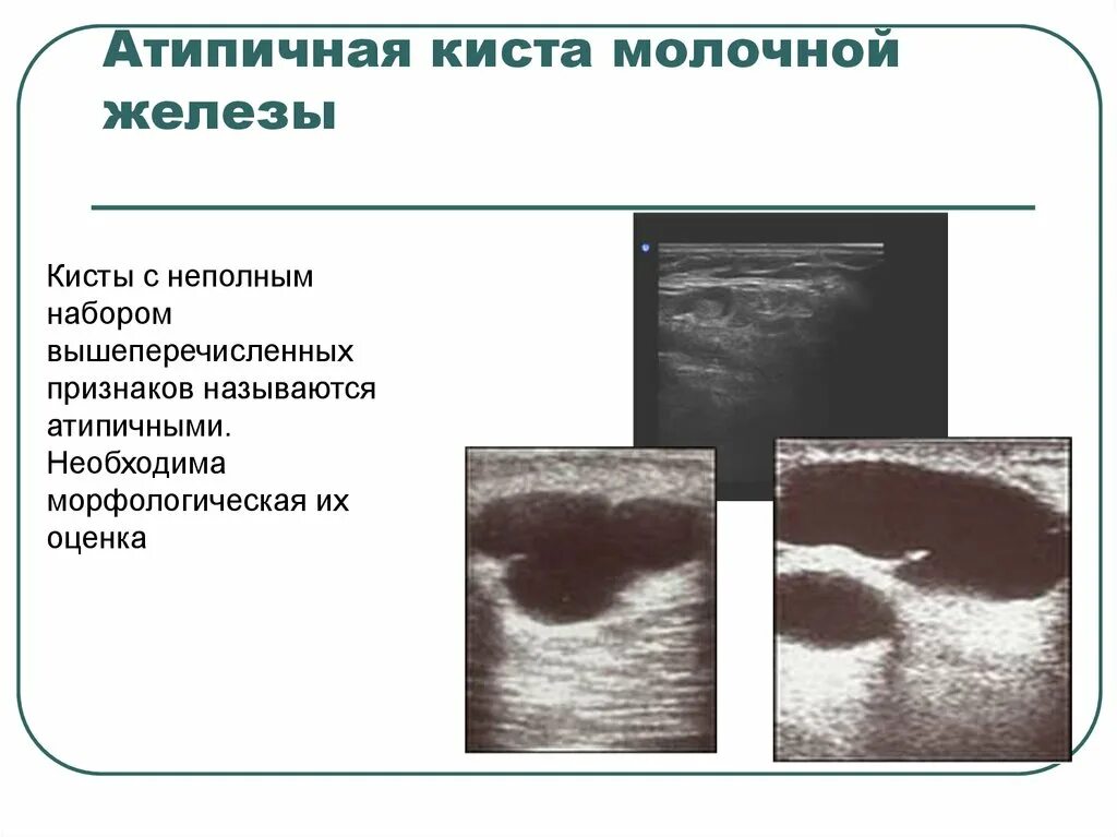 Можно с кистой в баню. Атипичная киста молочной. Киста молочной железы на УЗИ.